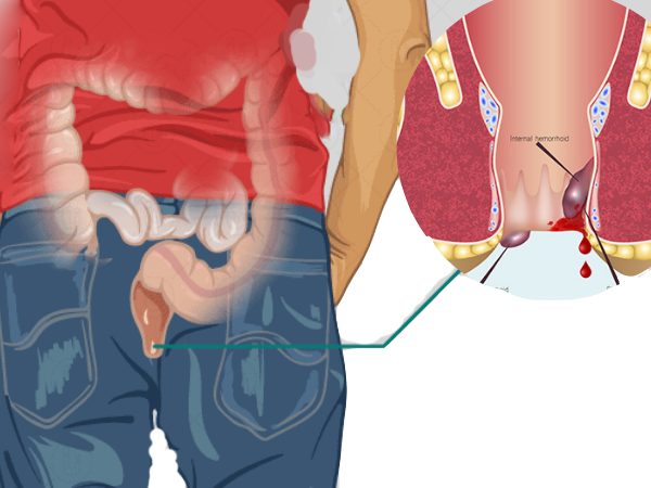 best fistula surgeon in Aurangabad- Dr. Anand Auti