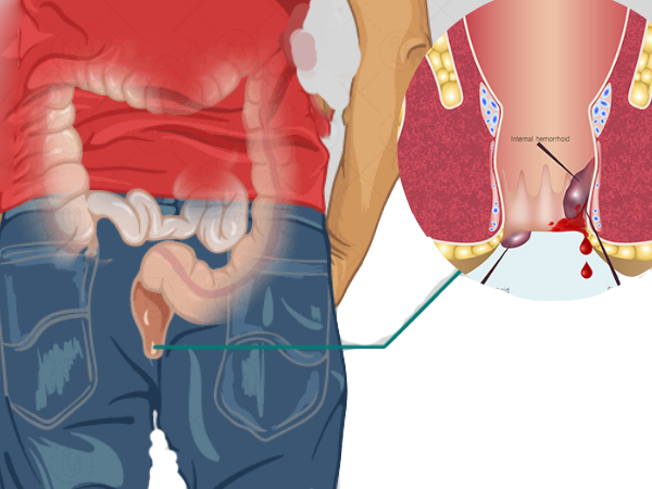 Haemorrhoids | Colorectal Surgeons Sydney